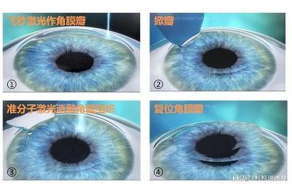 眼睛近视手术多少钱