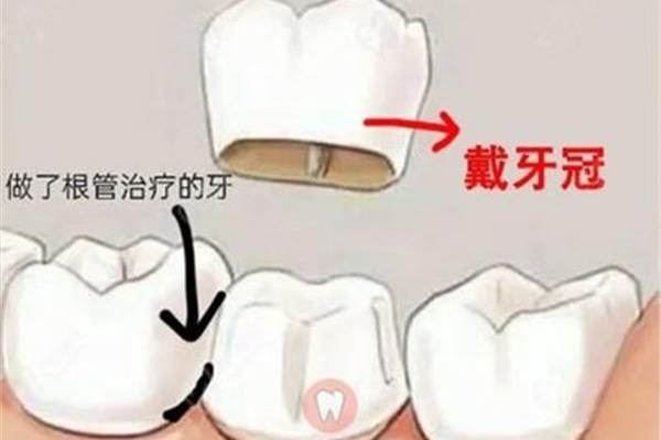 全瓷牙一颗大概多少钱