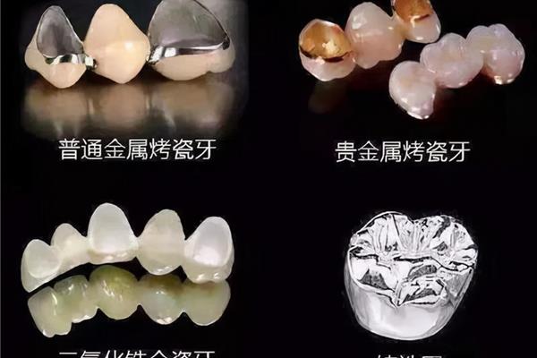 全烤瓷牙多少钱一颗