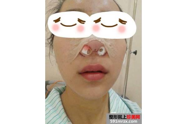 做鼻子多少钱